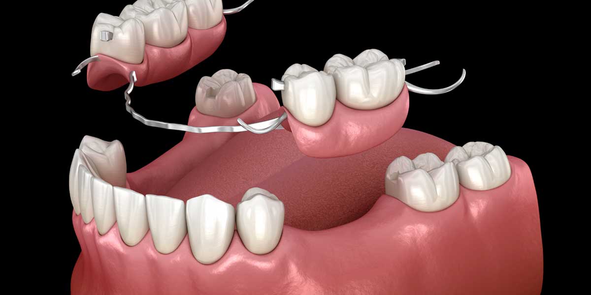 3D Dentures